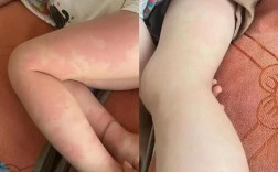 宝宝对虾过敏图片大全