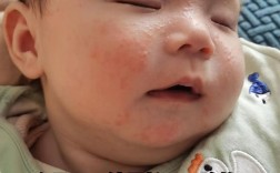 海鲜丸子吃后脸颊发红是过敏吗？