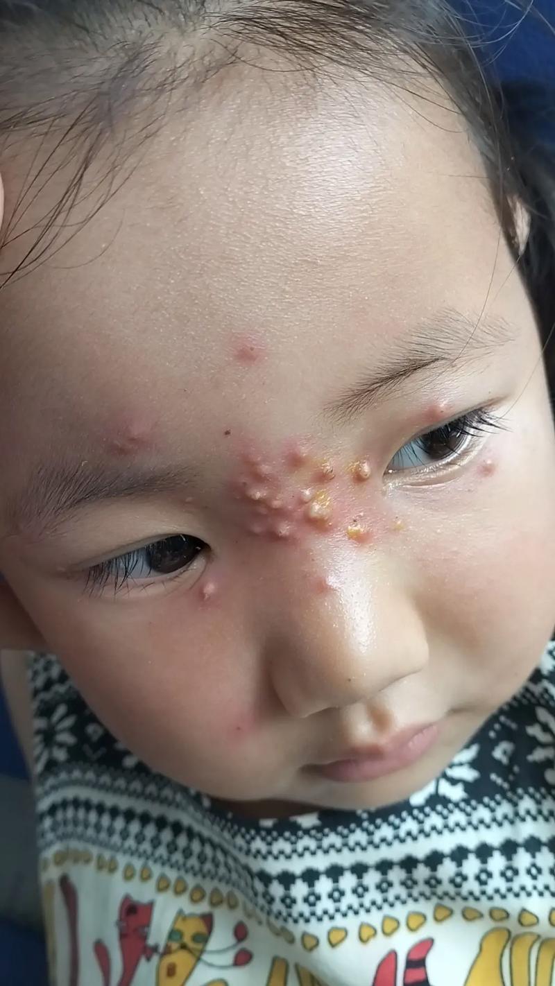 宝宝吃火龙果起疙瘩是过敏吗？-图1