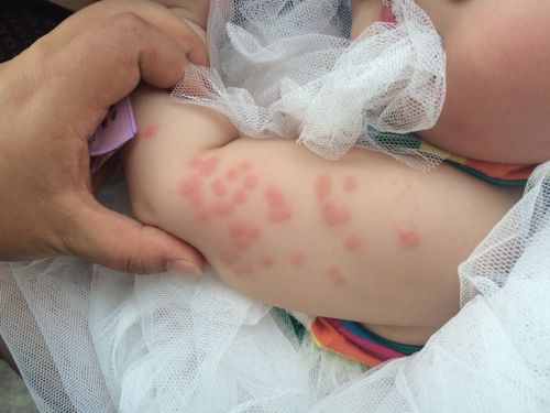 宝宝吃火龙果起疙瘩是过敏吗？-图3