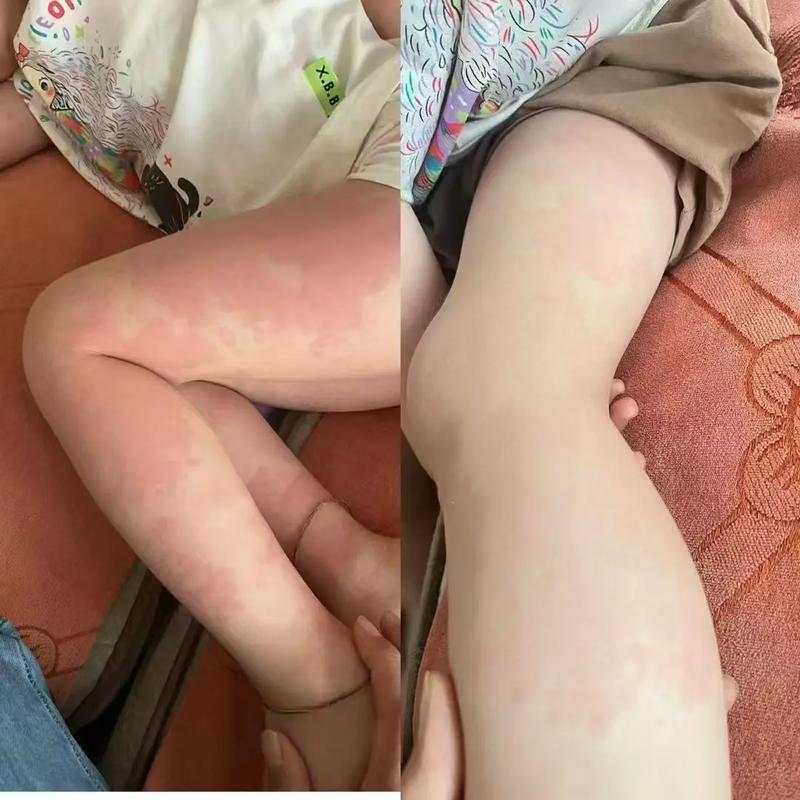 宝宝对虾过敏图片大全-图1 宝宝对虾过敏图片大全-图1