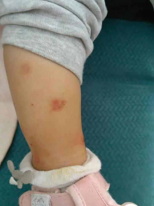 宝宝对虾过敏图片大全-图2 宝宝对虾过敏图片大全-图2