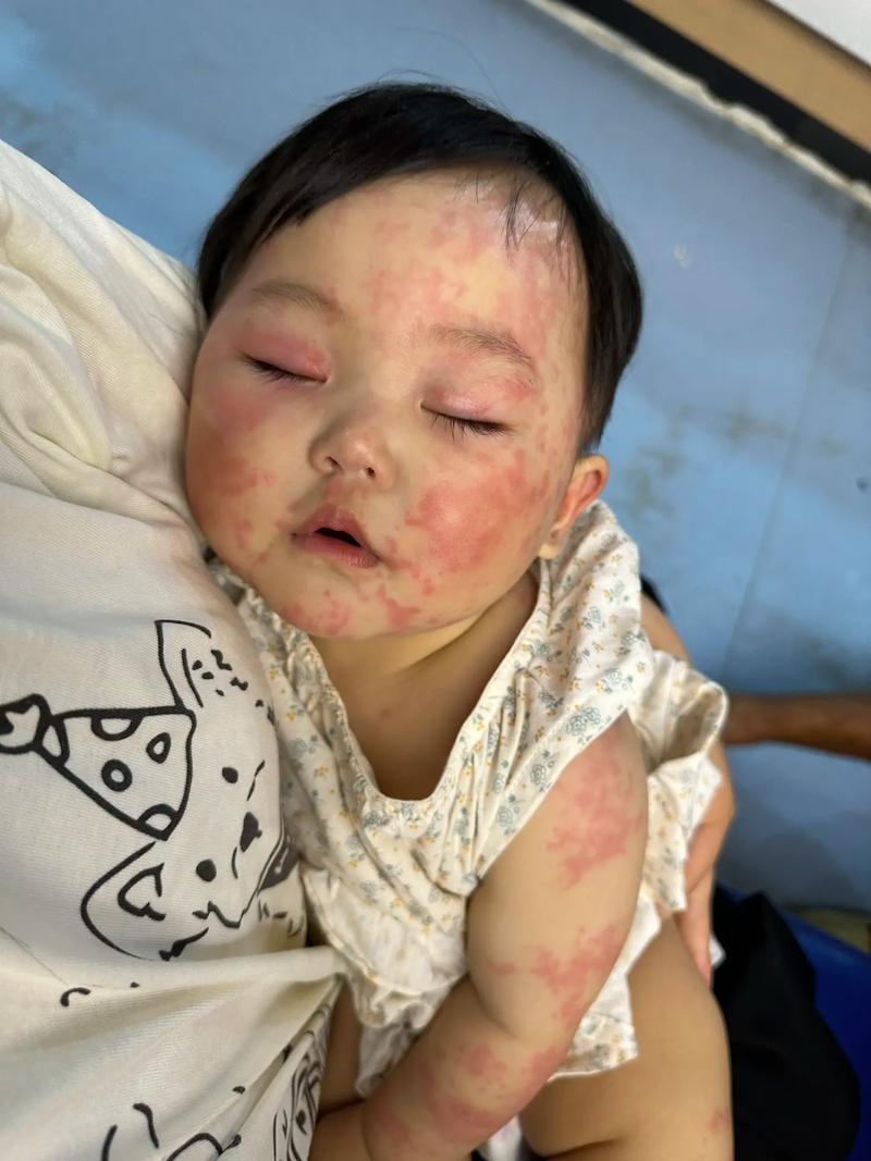 宝宝对虾过敏图片大全-图3 宝宝对虾过敏图片大全-图3