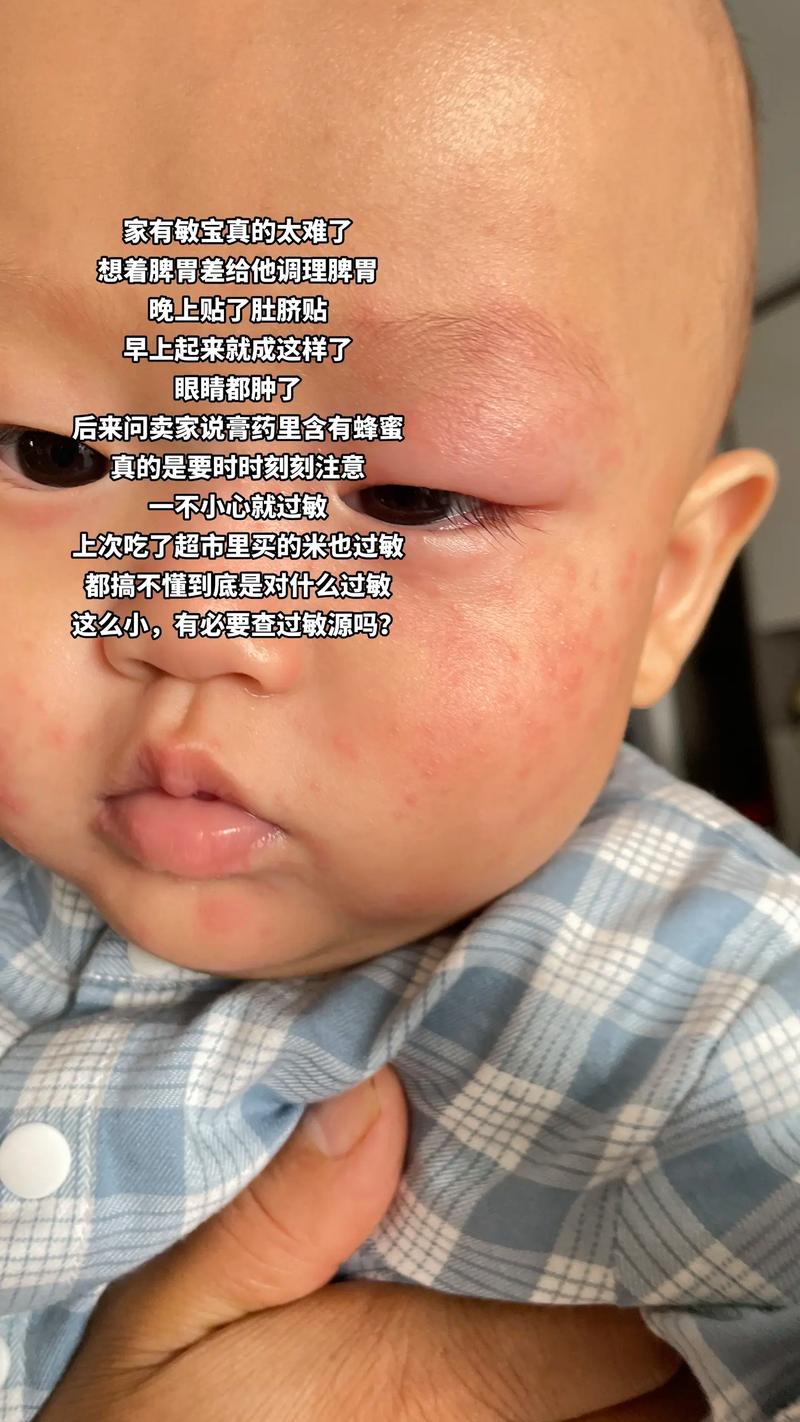 宝宝韭菜过敏图片大全-图2 宝宝韭菜过敏图片大全-图2