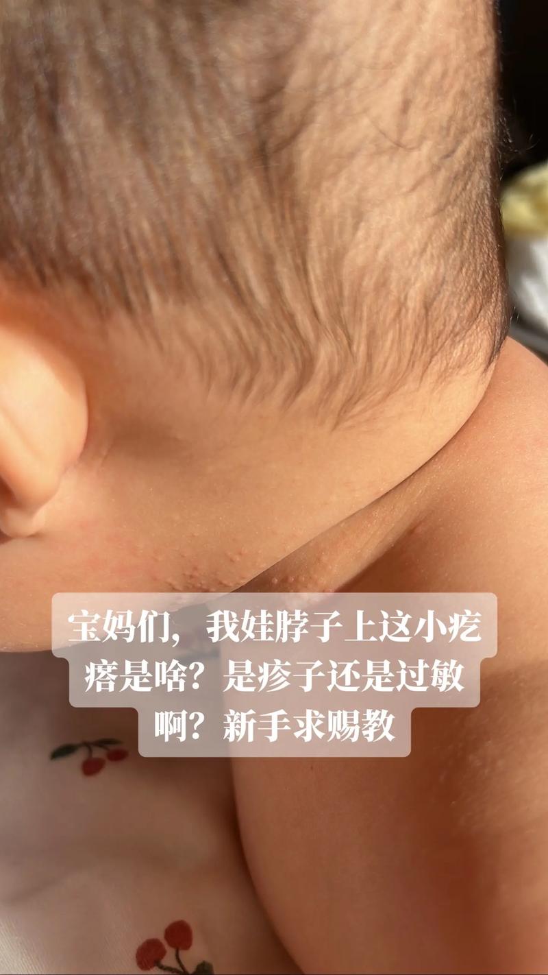 宝宝韭菜过敏图片大全-图3 宝宝韭菜过敏图片大全-图3