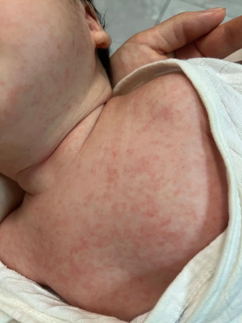 宝宝芹菜过敏图片有哪些症状？-图3