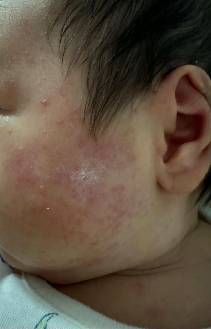 宝宝红薯过敏图片有哪些症状表现？-图1