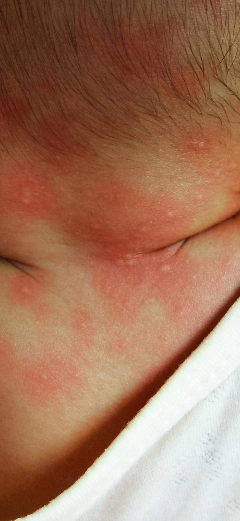 六个月宝宝胡萝卜过敏怎么办？-图3