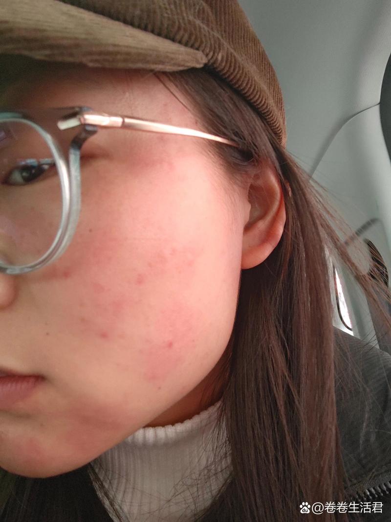 虾仁粥过敏怎么办？-图3