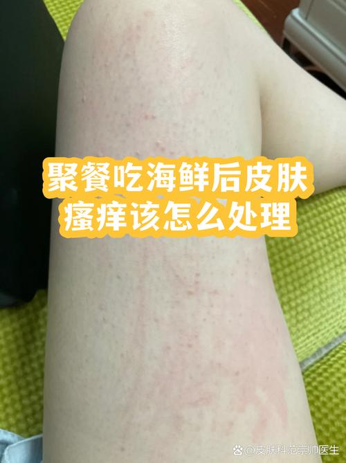 小儿海鲜过敏了该怎么办？-图3