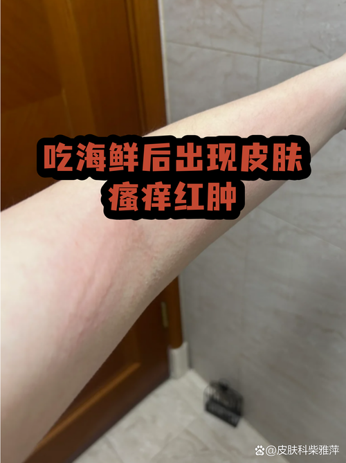 海鲜过敏后喝牛奶会加重吗？-图2